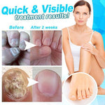 Load image into Gallery viewer, Anti-fungal Home Treatment Set
